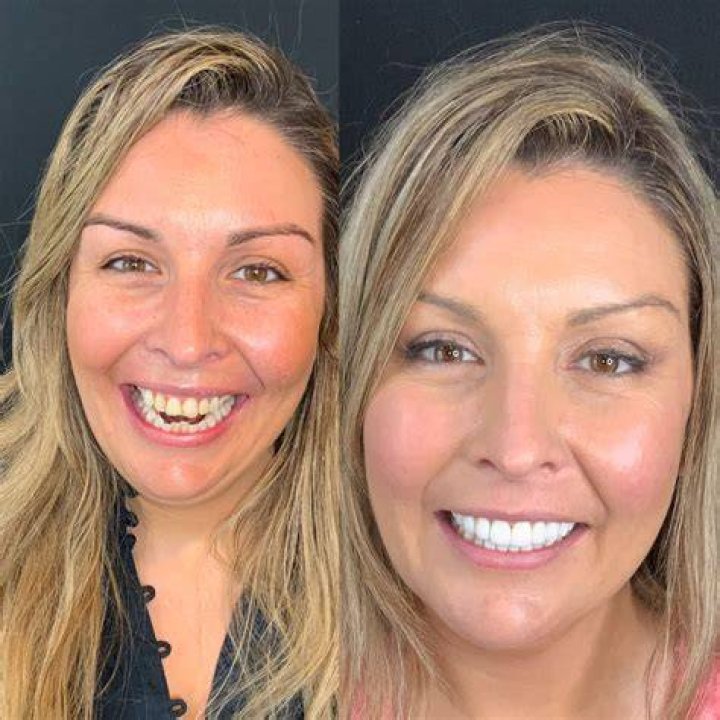 Celine Dio uses veneers for her upper teeth