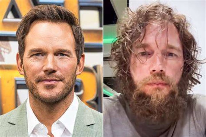 Chris Pratt with a swollen eye