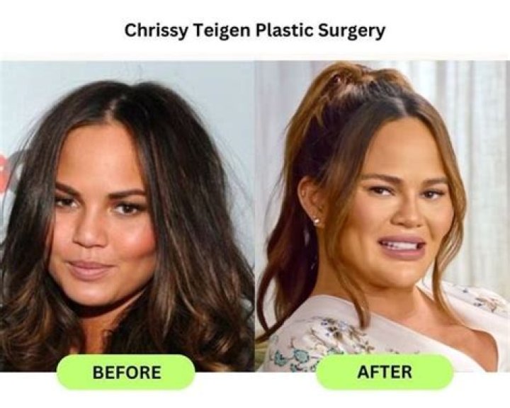Chrissy Teigen Shuts Down Plastic Surgery Rumors