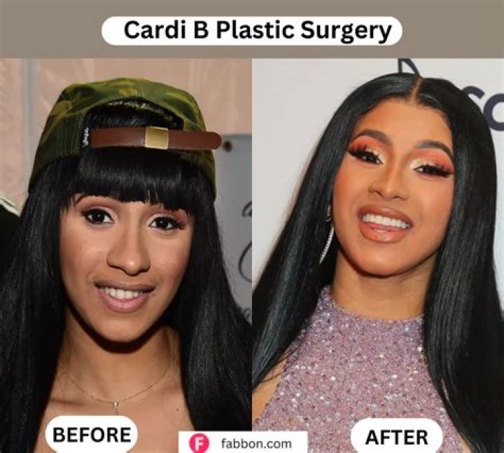 Did Cardi B get plastic surgery?