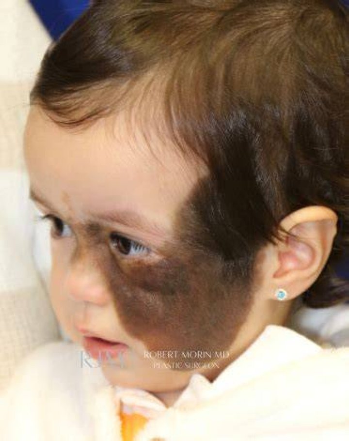 Giant Nevus on the Face