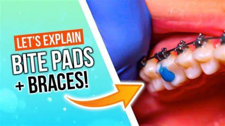 How To Remove Bite Blocks At Home