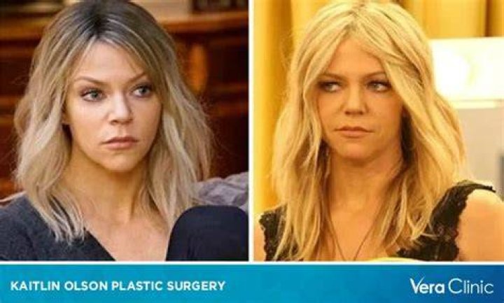 Kaitlin Olson After Facial Reconstructive Surgery Kaitlin Olson After Facial Reconstructive Surgery