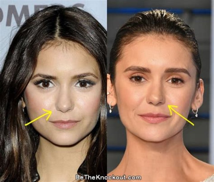 Nina Dobrev Plastic Surgery