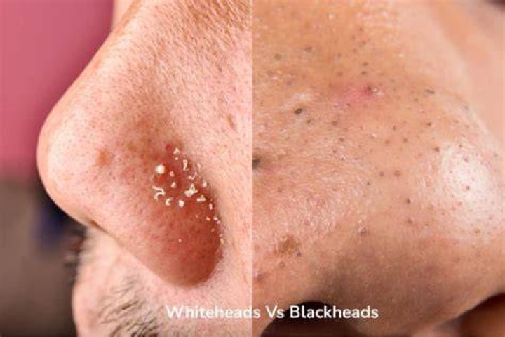The Difference Between Whiteheads and Blackheads