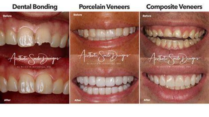 With veneers on his upper teeth, Nicolas Cage has the superstar appearance