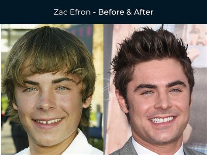 Zac Efron has six veneers on his upper teeth
